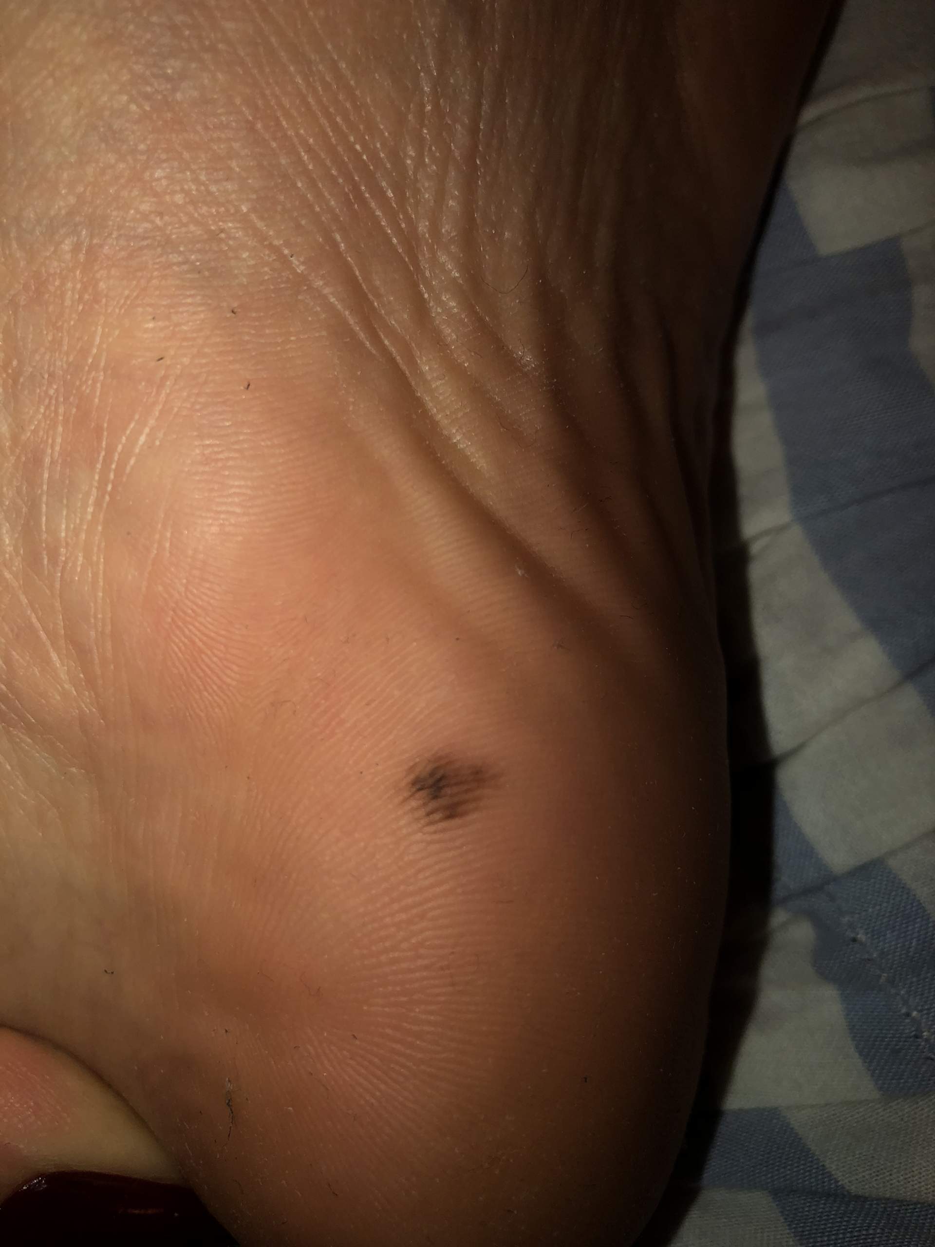 Hautkrebs fusssohle? (Füße)