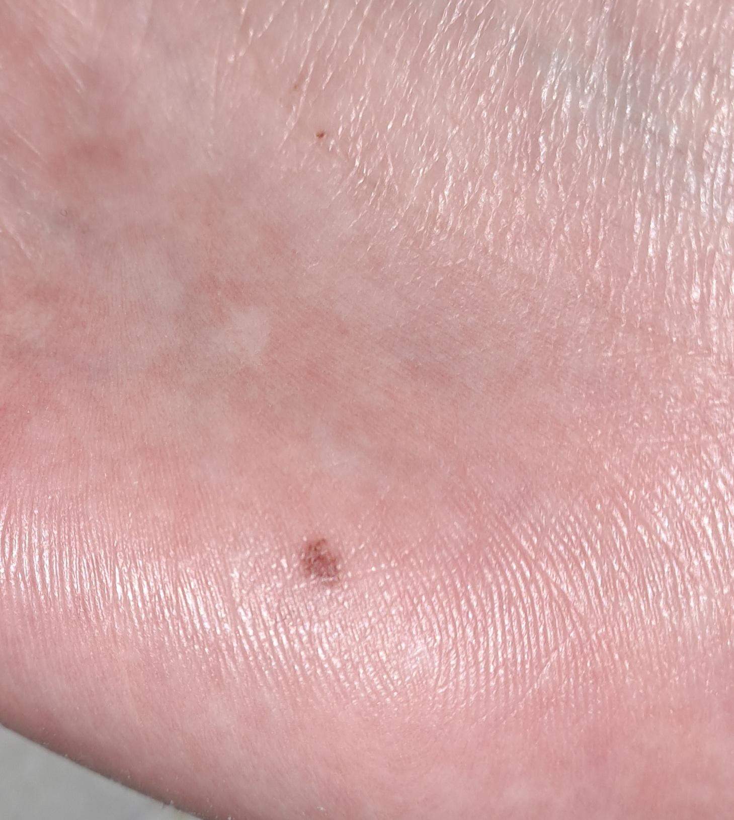 Hautkrebsverdacht wie schnell zum arzt? (Dermatologie, hautarzt, Hautkrebs)