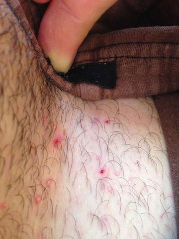 Hautproblem Weisse Pickel Haut Knubbel Hautproblem Weisse Pickel Haut Knubbel