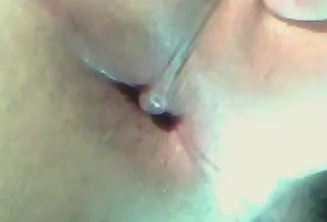 Hautsackchen Am After Haut Jucken Hautsackchen Am After Haut Jucken