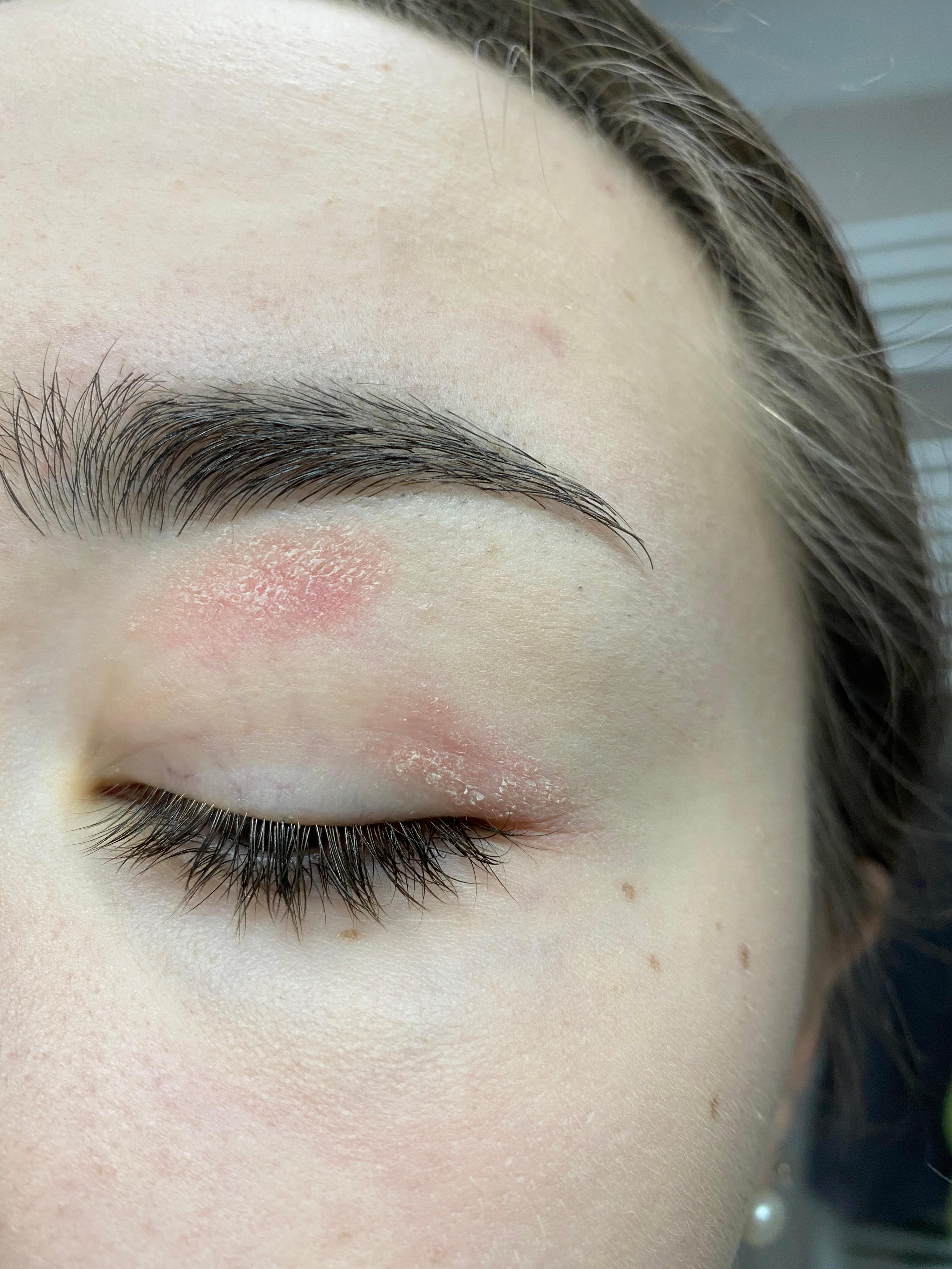 Hautveränderung am oberen Augenlid? (Haut, Augen, Ausschlag) Hautveränderung am oberen Augenlid? (Haut, Augen, Ausschlag)