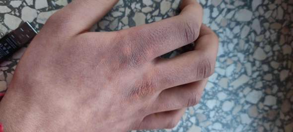 Hautverfärbung bei kalten Händen?