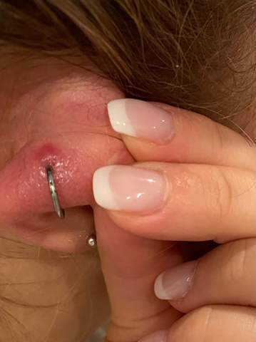 - (Entzündung, Piercing, helix piercing)