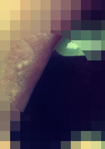 Bild Vergrößert - (Lippe, Herpes)