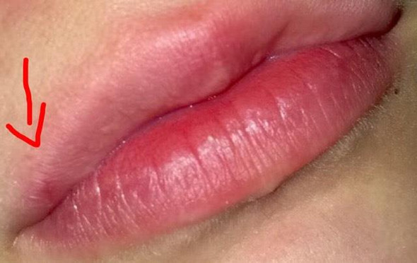 Herpes Pickel Oder Was Anderes Haut Dermatologie Lippe