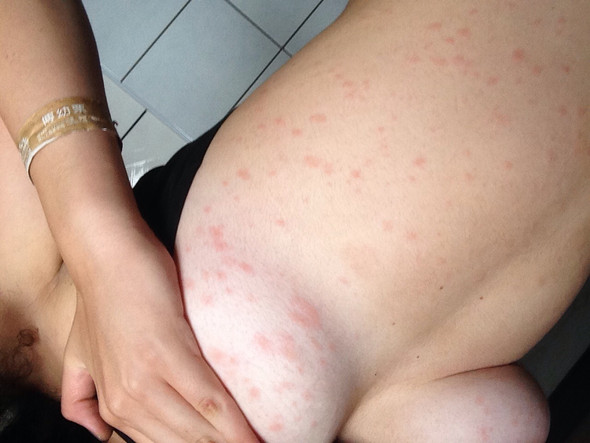 Ich Habe Einen Ausschlag Was Tun Haut Dermatologie Hautausschlag Ich Habe Einen Ausschlag Was Tun Haut Dermatologie Hautausschlag