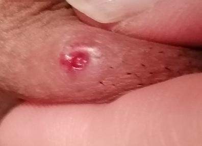 Hilfe Ist Es Syphilis Geschlechtskrankheit Hilfe Ist Es Syphilis Geschlechtskrankheit