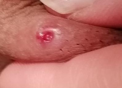 hilfe ist es syphilis