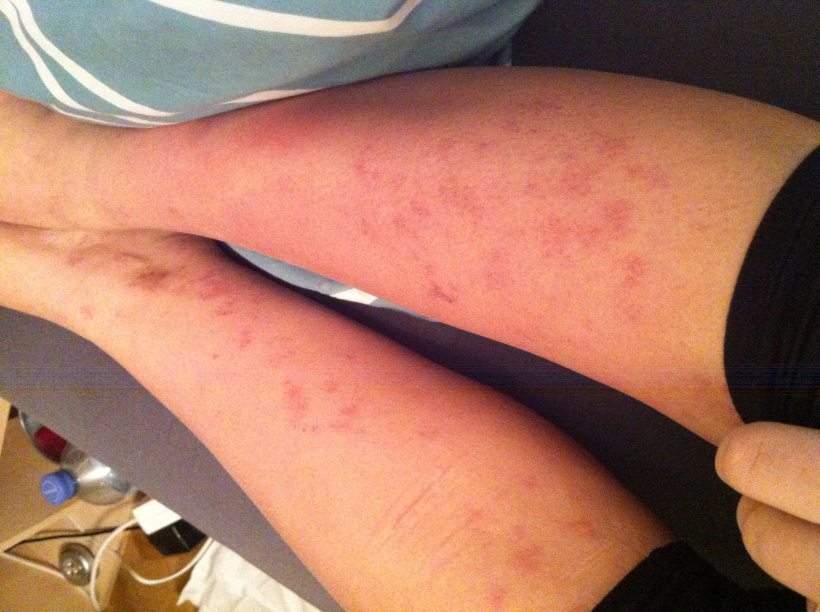 HILFE! rote Flecken auf den Beinen! (Haut, Medikamente, Medizin) HILFE! rote Flecken auf den Beinen! (Haut, Medikamente, Medizin)