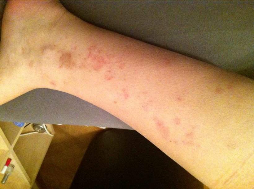 HILFE! rote Flecken auf den Beinen! (Haut, Medikamente, Medizin)