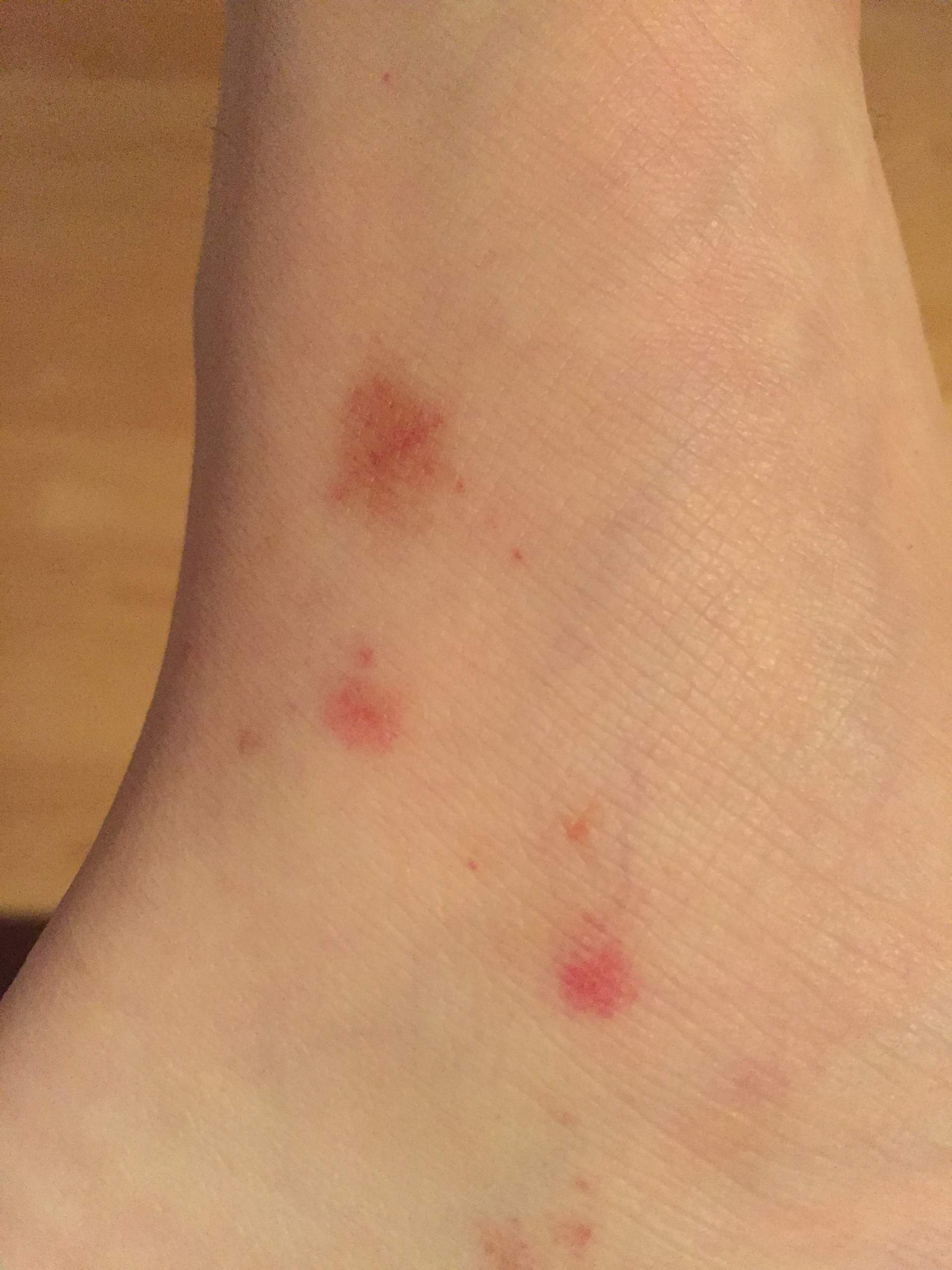 Hilfe!! Rote Flecken auf der Haut ? (Gesundheit)