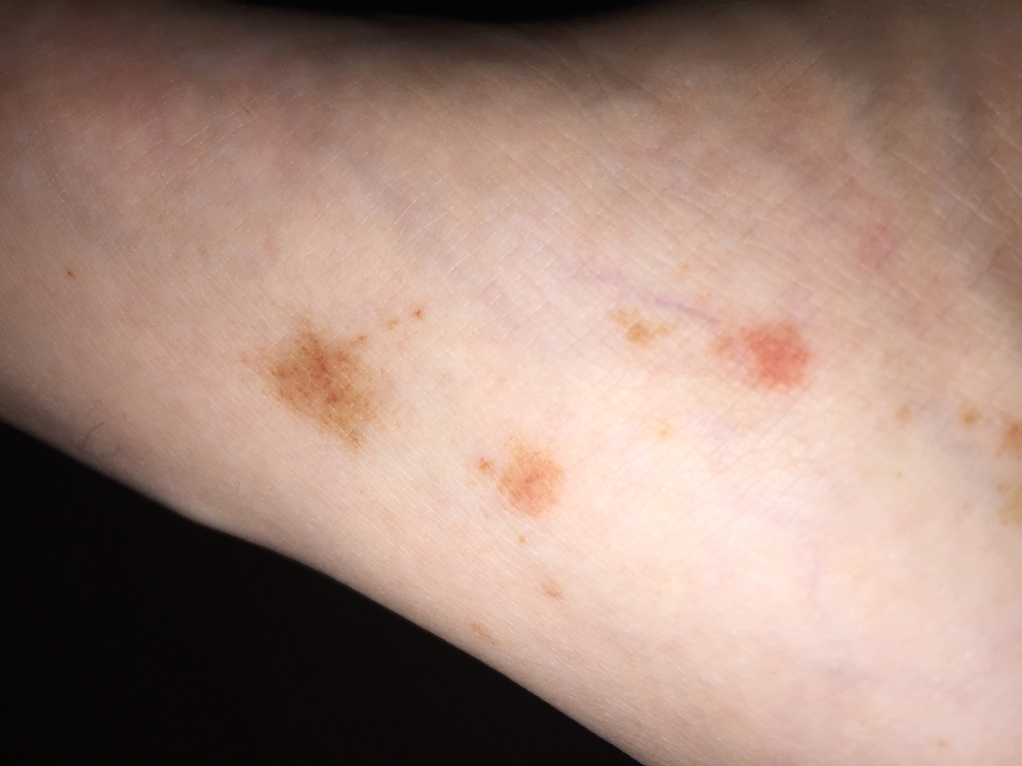 Hilfe!! Rote Flecken auf der Haut ? (Gesundheit) Hilfe!! Rote Flecken auf der Haut ? (Gesundheit)