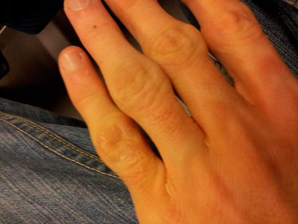 Finger 1 - (Haut, Hand, schmerzhaft)