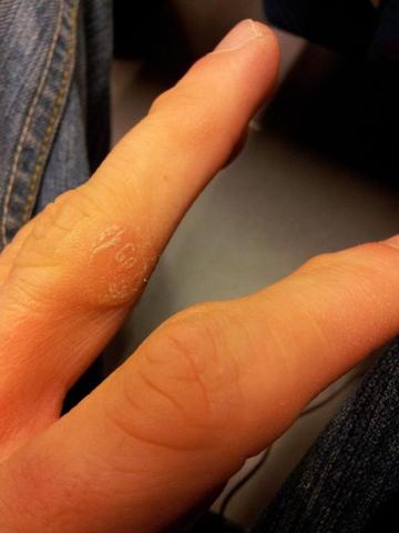 Finger 2 - (Haut, Hand, schmerzhaft)