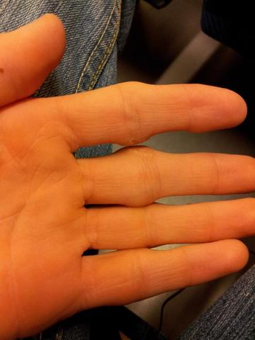 Finger3 - (Haut, Hand, schmerzhaft)