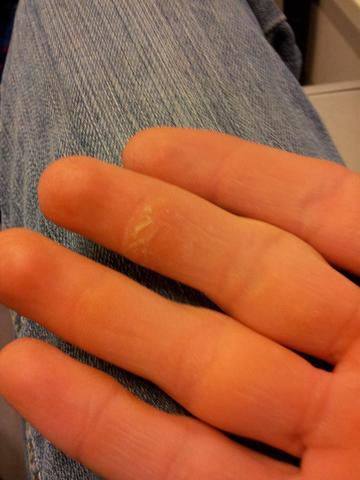 Finger 4 - (Haut, Hand, schmerzhaft)