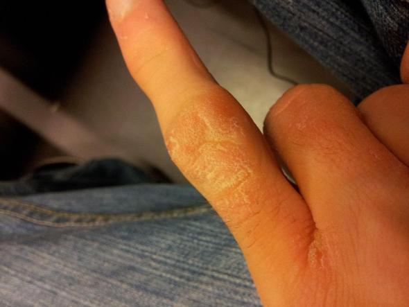 Finger 5 - (Haut, Hand, schmerzhaft)
