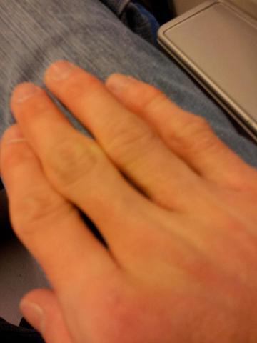 Finger 6 - (Haut, Hand, schmerzhaft)