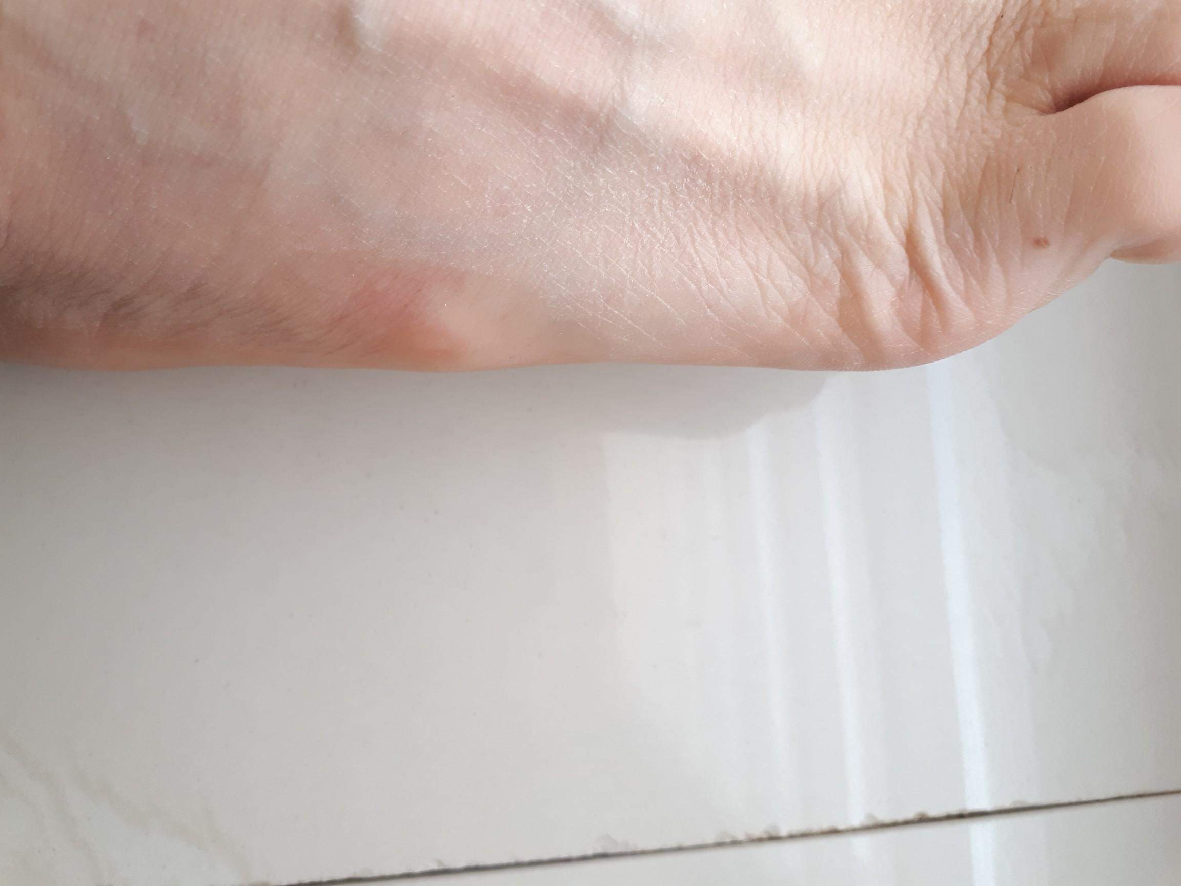 Hubbel seitlich am Fuß. Ganglion? Was machen? (Füße, geschwollen ...