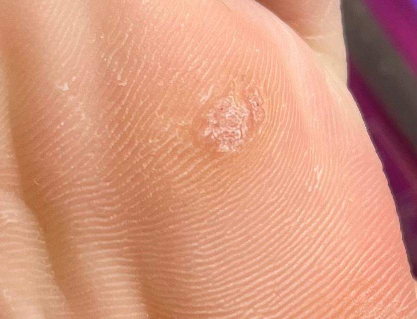 Hühnerauge oder doch was anderes? (Füße, Warzen, dornwarze)