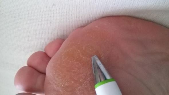 huhnerauge operativ entfernen lassen