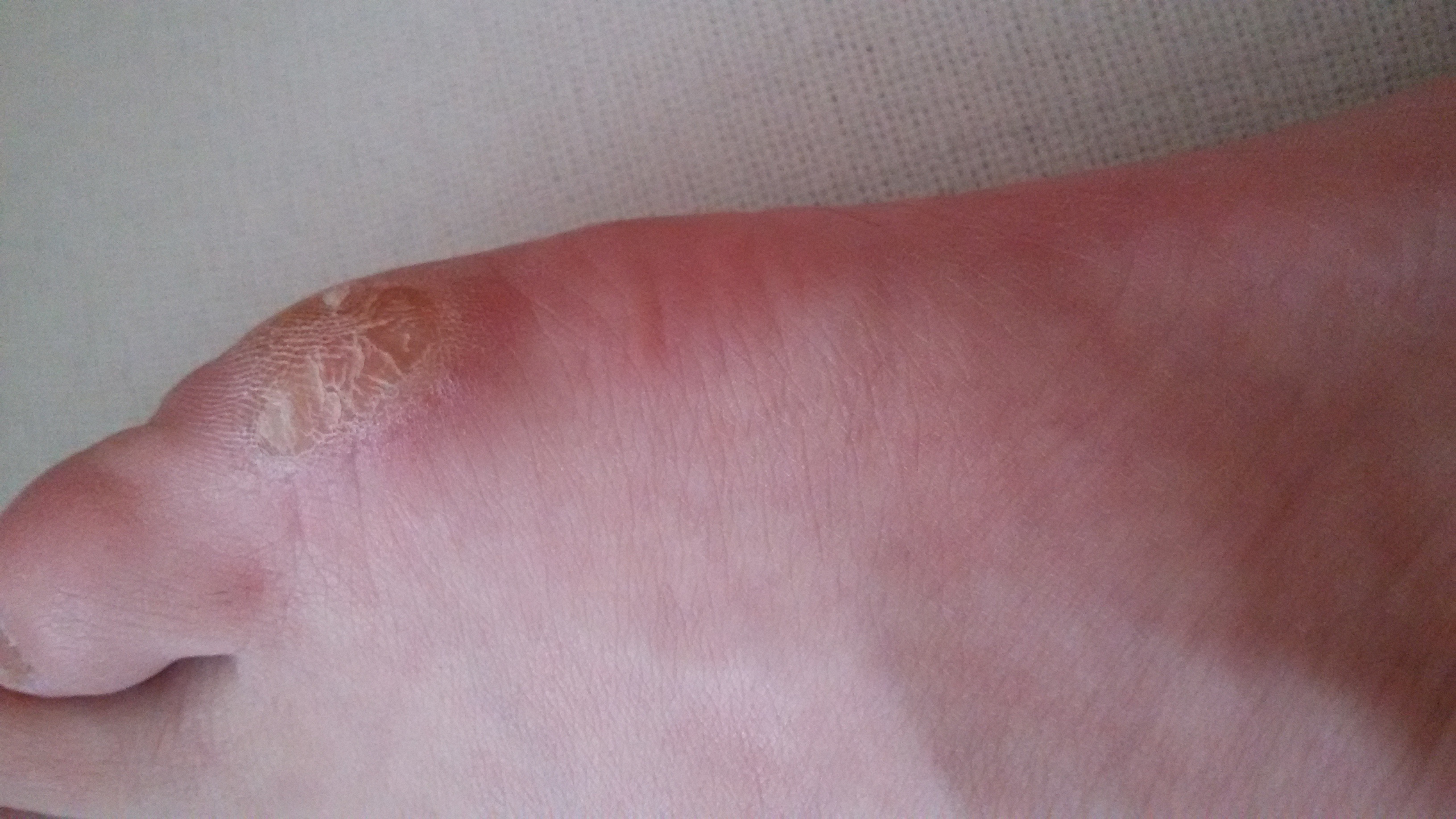 Hühnerauge operativ entfernen lassen? (Schmerzen, Haut, Operation) Hühnerauge operativ entfernen lassen? (Schmerzen, Haut, Operation)