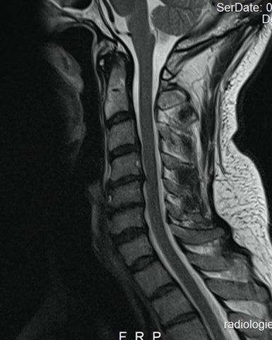 Hws Beschwerden Seit 3 Jahren Befund Hws Beschwerden Seit 3 Jahren Befund