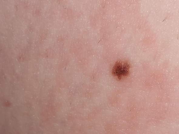 Ich Bin 15 Jahre Alt Ich Habe Auf Diesem Leberfleck Kleine Schwarze Punkte Ist Das Schlimm Haut Ich Bin 15 Jahre Alt Ich Habe Auf Diesem Leberfleck Kleine Schwarze Punkte Ist Das Schlimm Haut