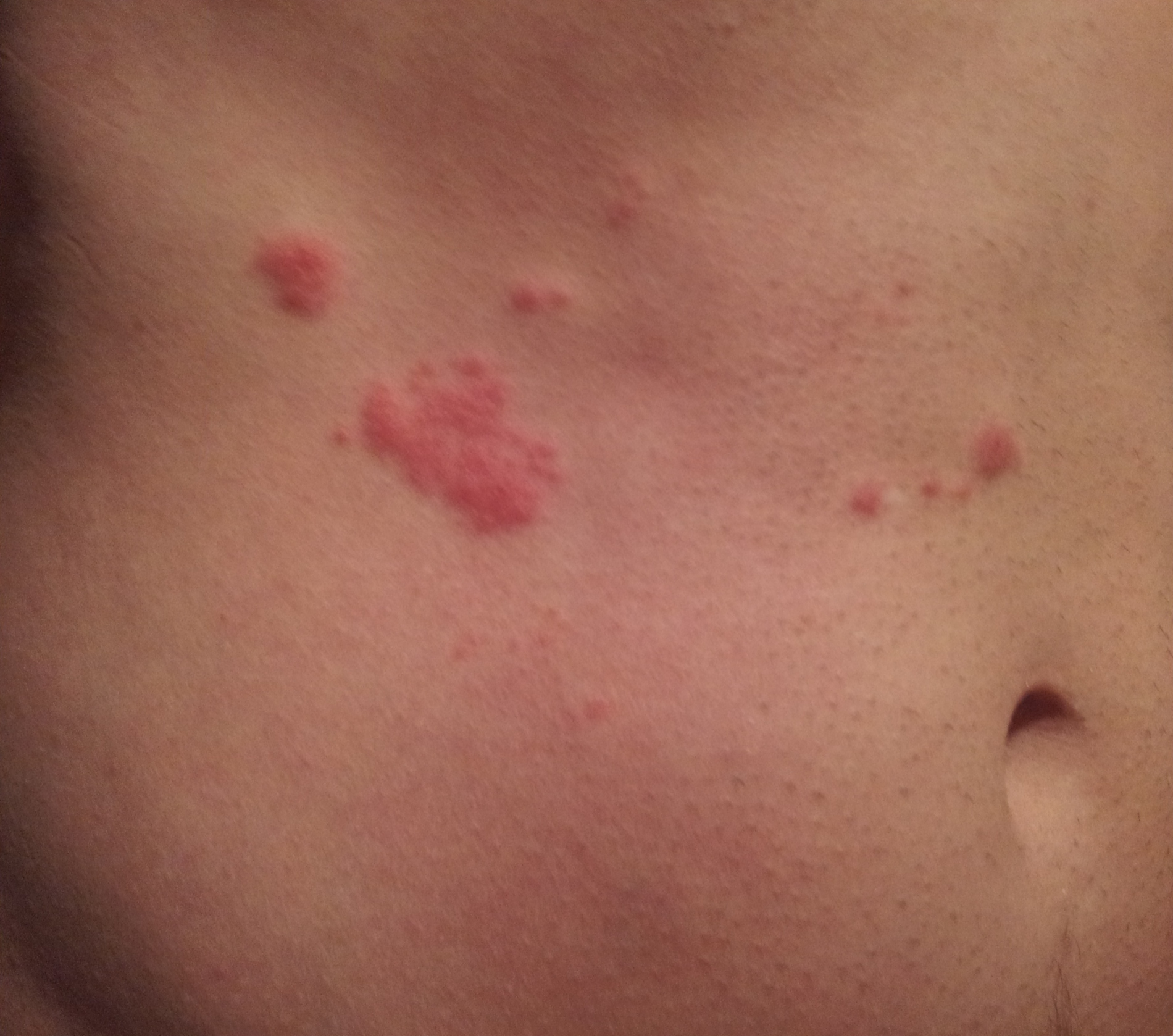 Ich brauche ganz dringend Hilfe ! Was ist das für ein Ausschlag Ich brauche ganz dringend Hilfe ! Was ist das für ein Ausschlag