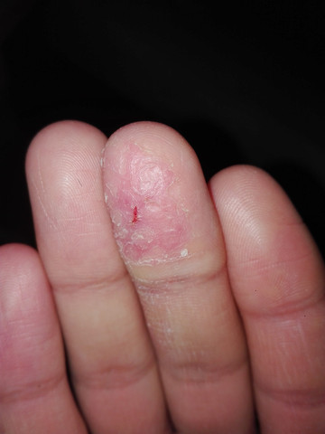 Ich habe das am Finger schon mehrere Monate (siehe Bild) - es geht aber nicht weg - könntet ihr mir helfen?