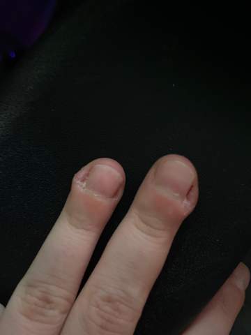 Ich habe seit einer Woche 1 Beule jeweils an 2 Fingern wie bekomme ich die weg bzw zu welchen Arzt müsste ich gehen und was könnte das?