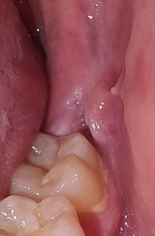 Ich habe seit gestern so ein Loch oder so hinten unten links im Zahnfleisch, kann mir jemand was das ist und ob ich zum Zanharzt muss oder nicht?