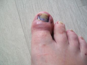 Wie den abgeschlagenen Nagel des Fingers der Hand zu behandeln