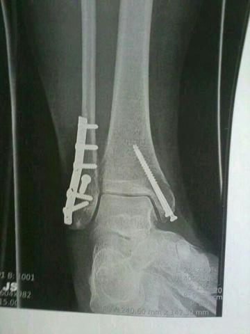 Röntgenbild  - (Füße, Schwellung, Sprunggelenk)