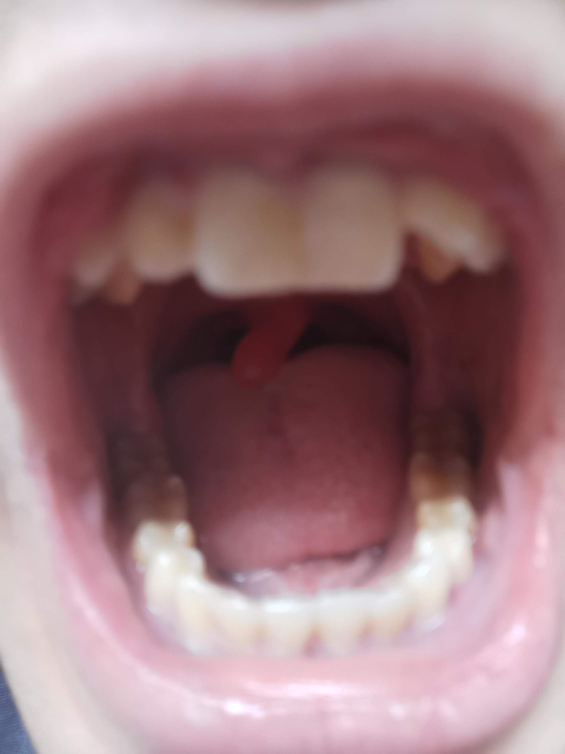 Innerhalb einer Nacht kompletter Fremdkörper im Mund? (Schmerzen, Zahnarzt, Tumor)