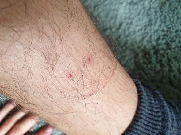 Insektenstich, Zecke, rote Punkte auf der Haut am Bein?