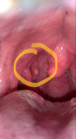 Traitement du papillomavirus. Vaccin papillomavirus interdit, Recidive hpv apres hysterectomie