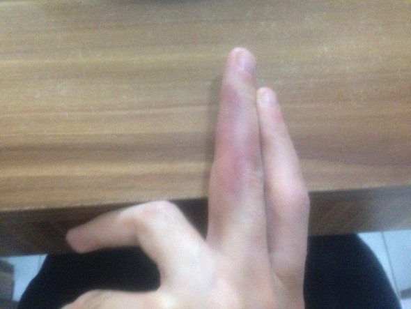 Bild 1 - (Finger, Hämatom)