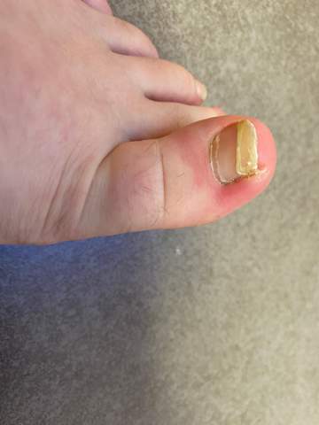 Ist Das Ein Nagelpilz Fusse Pilze Fussnagel Ist Das Ein Nagelpilz Fusse Pilze Fussnagel