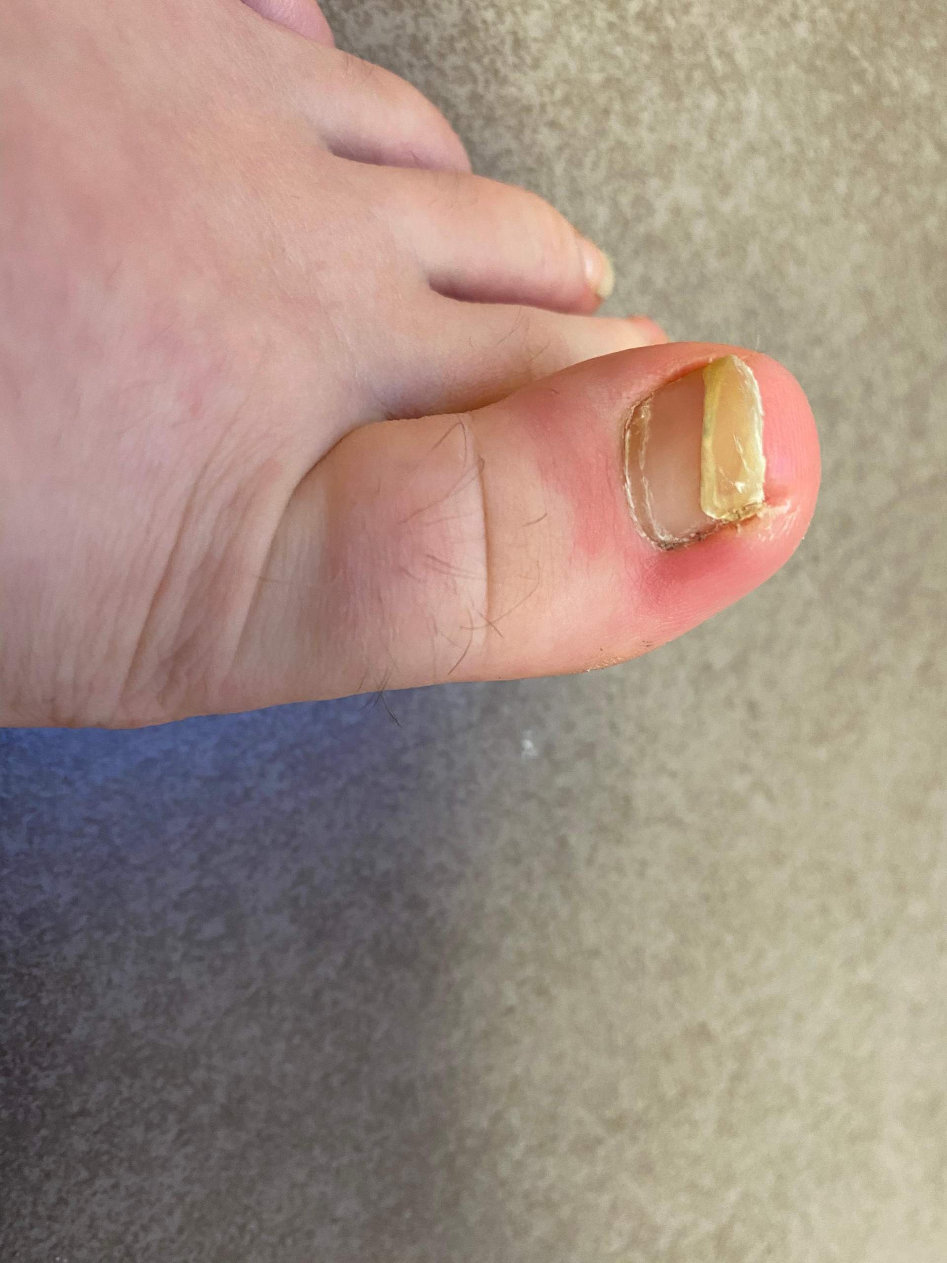 Ist das ein Nagelpilz? (Füße, Pilze, Fußnägel) Ist das ein Nagelpilz? (Füße, Pilze, Fußnägel)