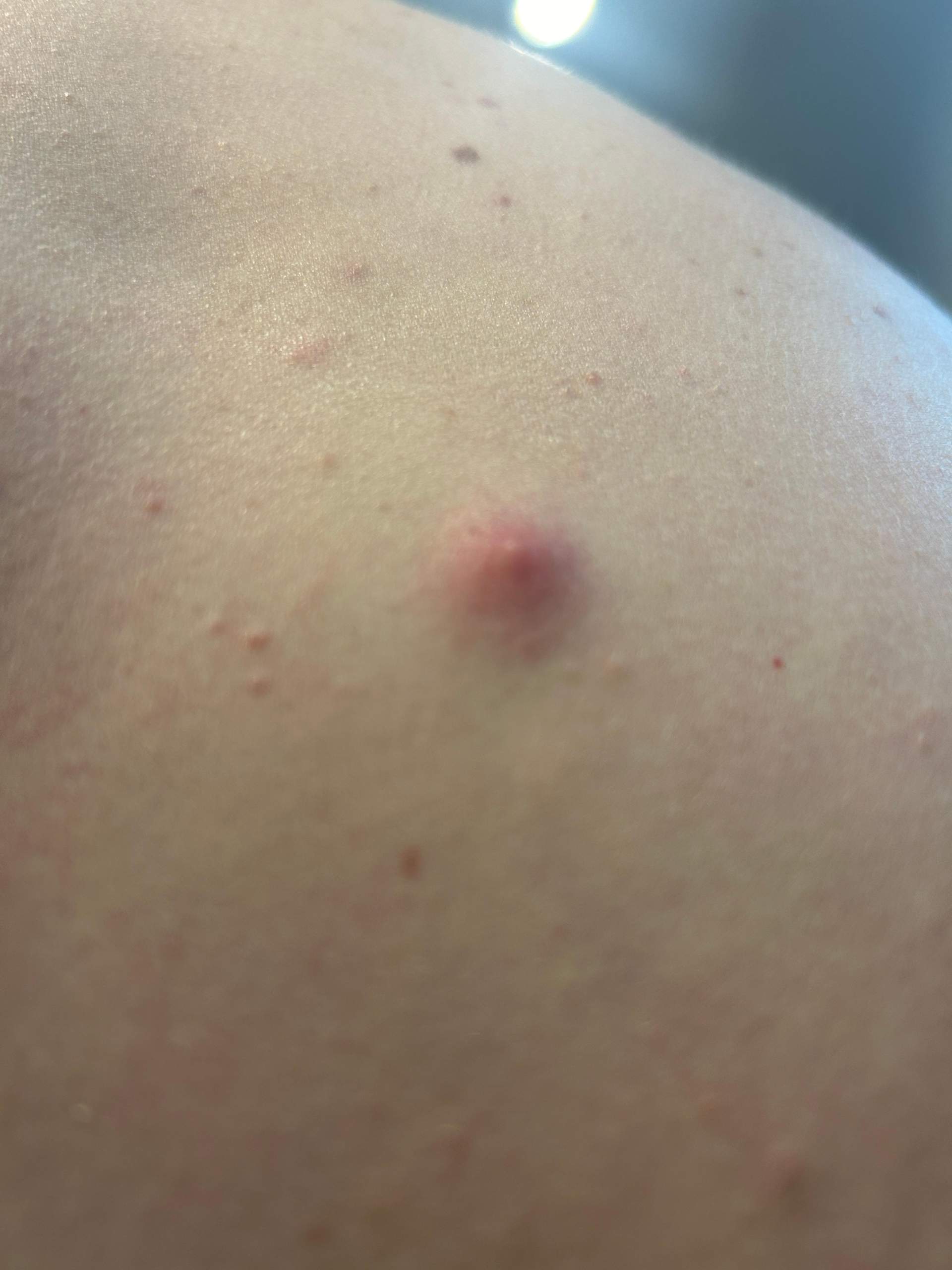 Pickel Am Hoden Hautarzt Oder Urologe Ist das ein Pickel oder Mückenstich?