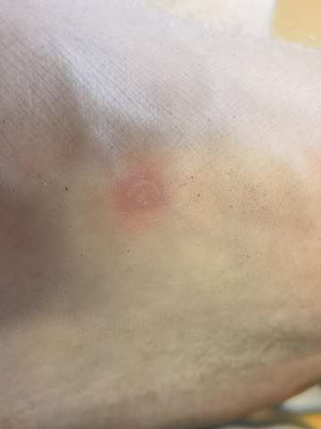 Ist das eine Blase?