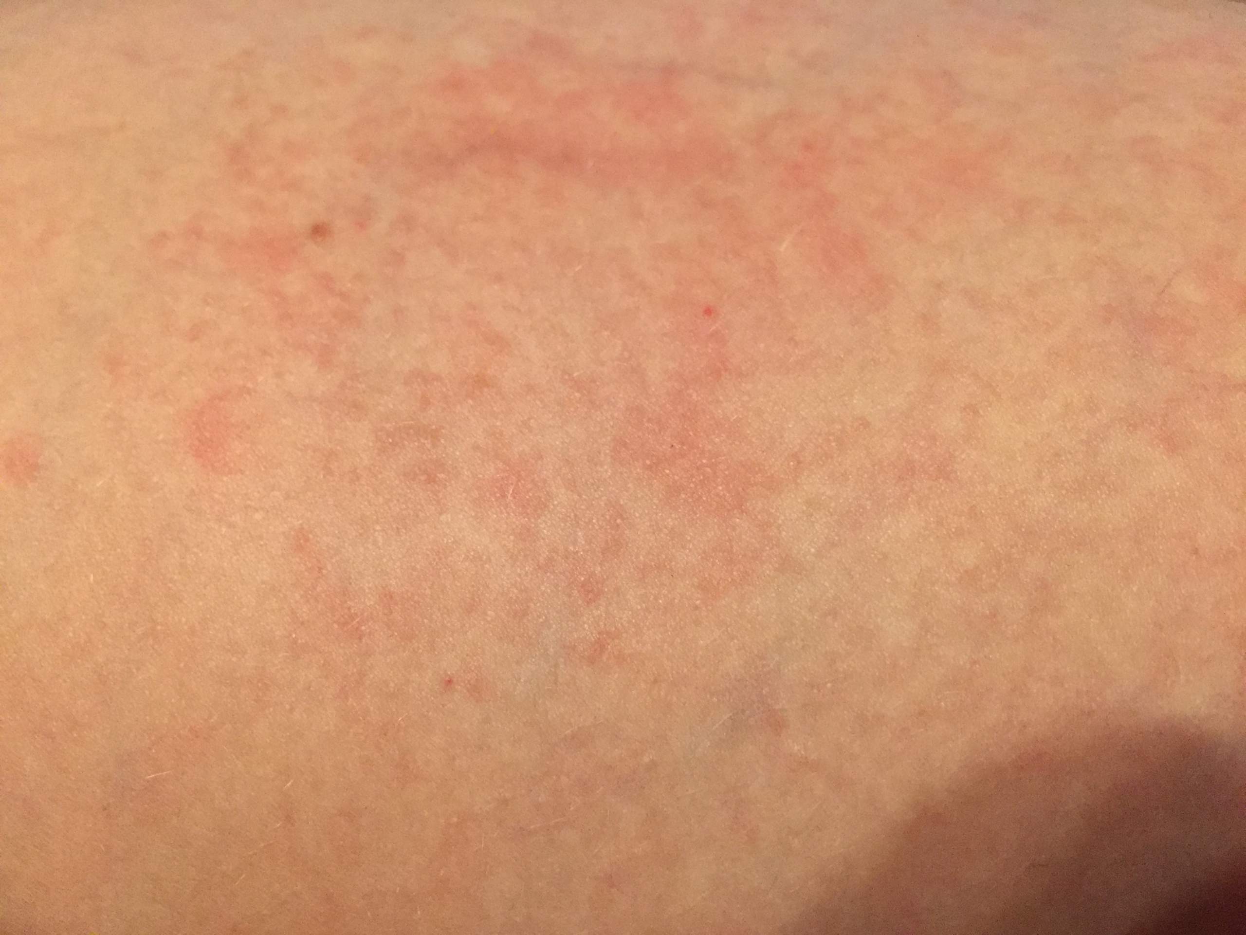 Ist das eine Kontaktallergie (mit Bild)? (Haut, Gesundheit, Allergie)
