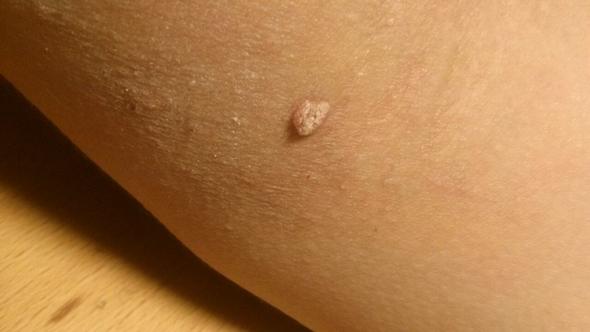 Ist das eine Warze? (Arm, Warzen) Ist das eine Warze? (Arm, Warzen)