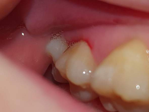 Ist das eine Zahnfleischentzündung?