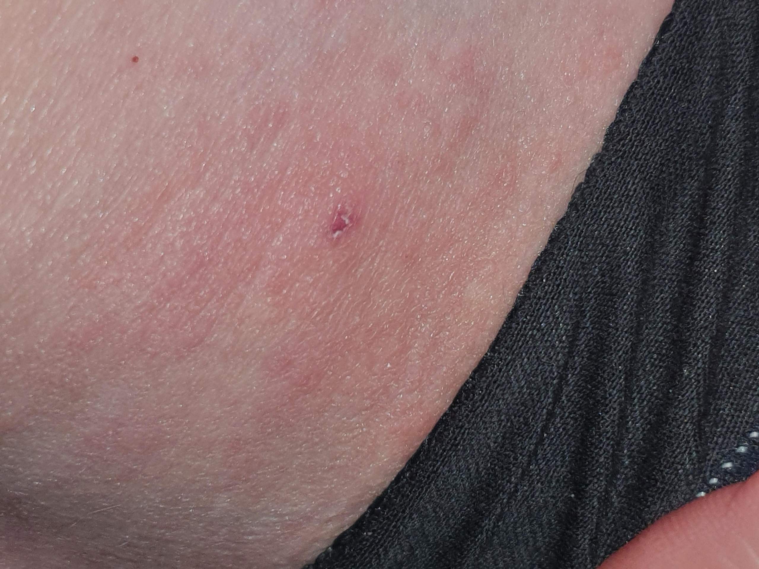 ist das Ekzem oder krätze? (Juckreiz)