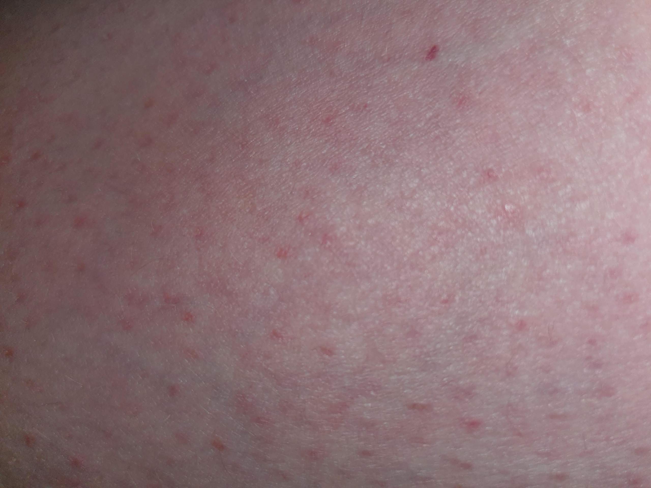 ist das Ekzem oder krätze? (Juckreiz)