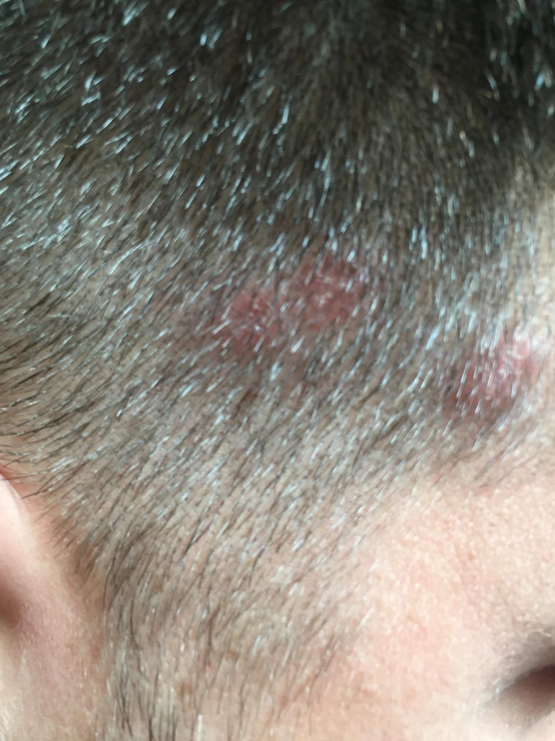 Ist das gefährlich diese pickel? (Entzündung) pickel entzündung