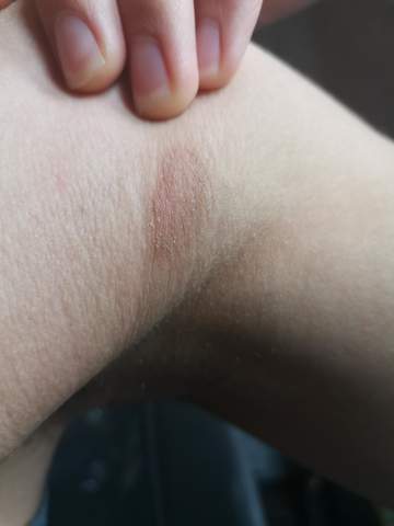 Ist Das Hautkrebs Haut Krebs Muttermal Ist Das Hautkrebs Haut Krebs Muttermal