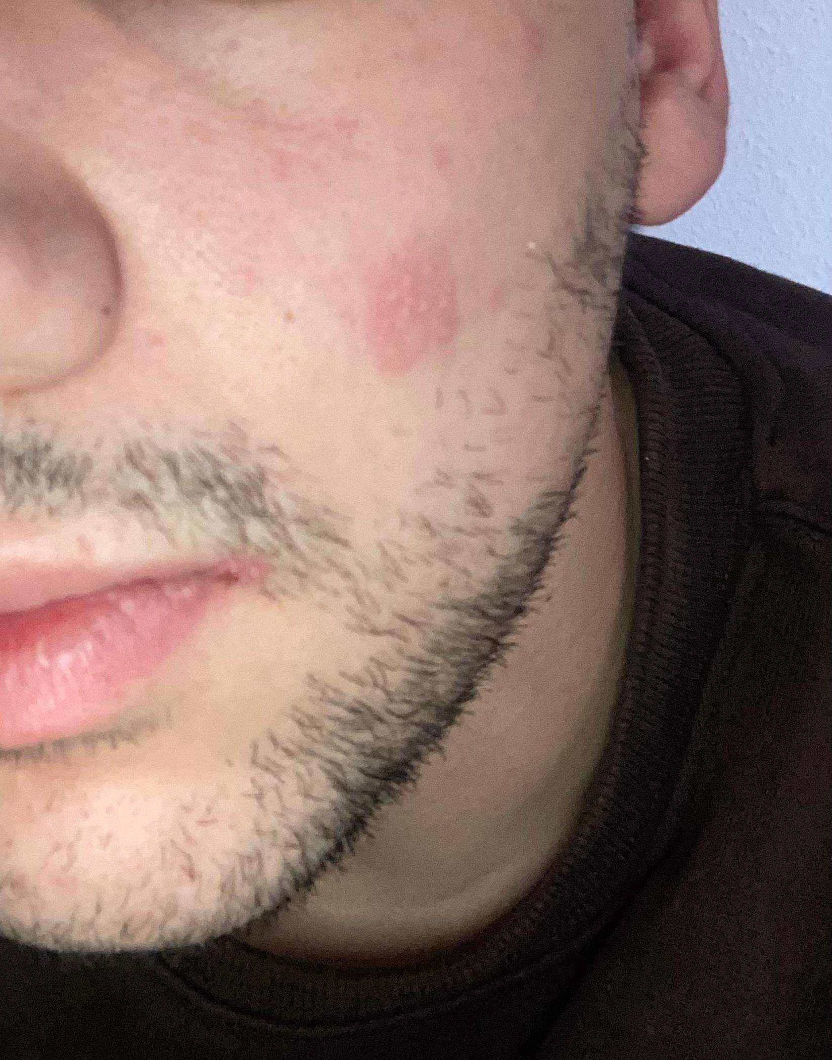 Ist das Herpes? (Haut, Ausschlag)